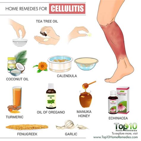 Cellulitis: Home Treatment & How to Prevent It - eMediHealth | Home health remedies, Remedies ...