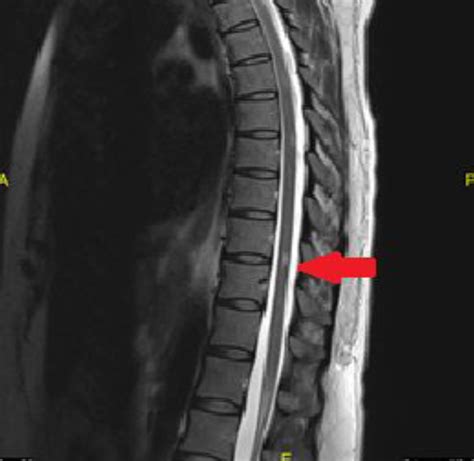 Thoracic Spine Mri Multiple Sclerosis