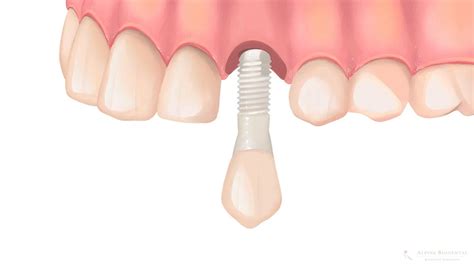 Ceramic implant: advantages, disadvantages and more | Alpine BioDental