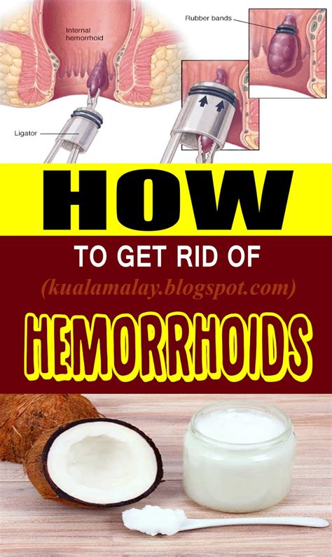 How to Get Rid of Hemorrhoids without Surgery