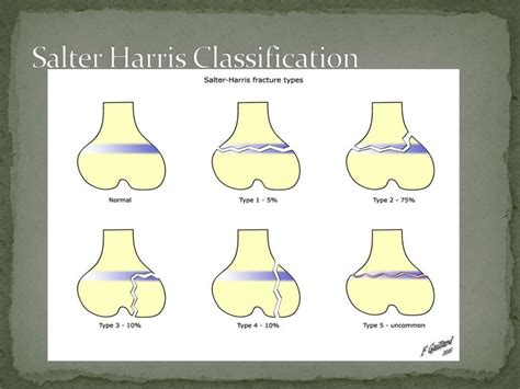 Salter Harris Type 3 Fracture