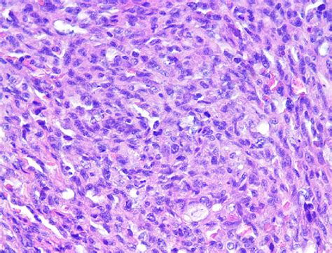 Hemangiosarcoma. Solid type. Solid cords formed by proliferating ...