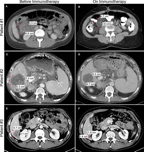 Frontiers | The Role of Palliative Surgery for Malignant Bowel Obstruction and Perforation in ...