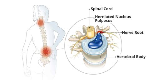 Slipped Disc » Raffles Orthopaedic Centre, Singapore