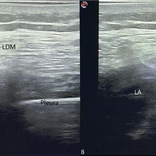 Combined serratus anterior plane block. A: Anatomical scene before the ...