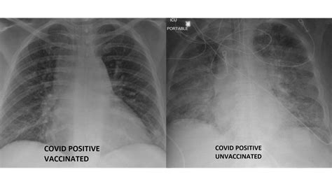 COVID-19 lung X-rays show difference between vaccinated, unvaccinated patients | FOX 29 Philadelphia