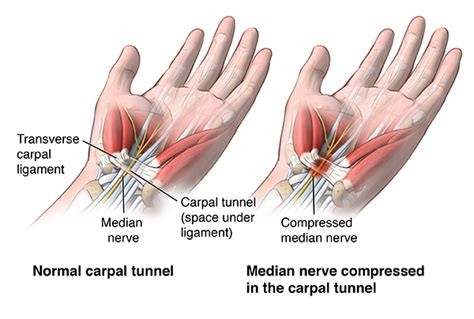 Carpal Tunnel Syndrome | Johns Hopkins Medicine