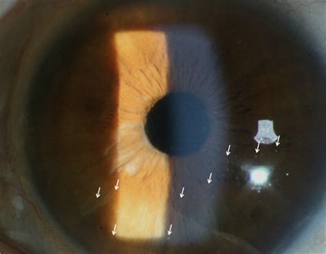 Slit-lamp biomicroscopic findings in our uveitis patient. The slit-lamp ...