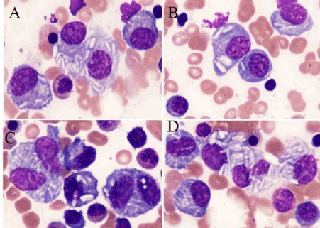 White rodlike crystals in multiple myeloma cells