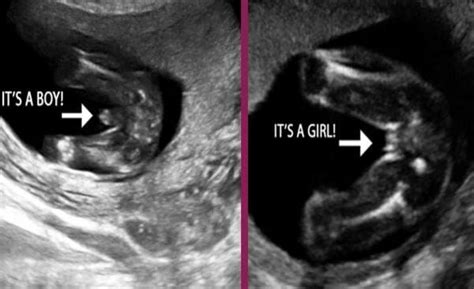 Gender reveal ultrasound | Gender reveal ultrasound, Baby gender ...