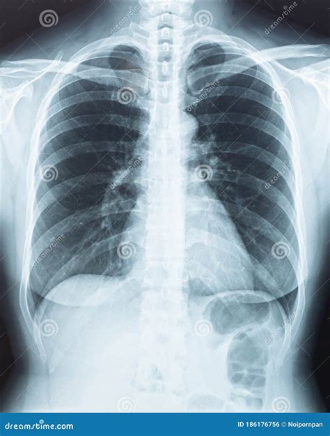 Chest X-ray of Human Physical Body Radiography with Digital Imaging Film Displaying Internal ...