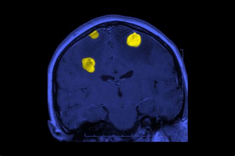 Novel Immunotherapy May Increase Survival in Melanoma With Brain Metastases - Dermatology Advisor