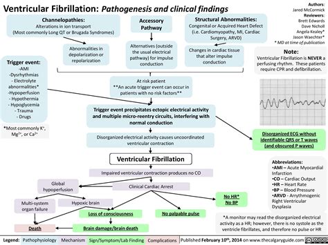 Ventricular Fibrillation: Pathogenesis and clinical findings | Calgary ...