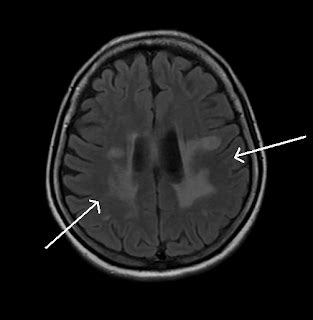 Multiple Sclerosis-MRI - Sumer's Radiology Blog