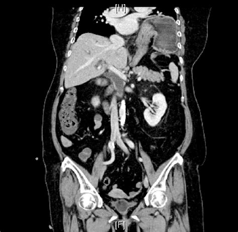 CT scan with mesentero-axial type gastric volvulus. | Download Scientific Diagram