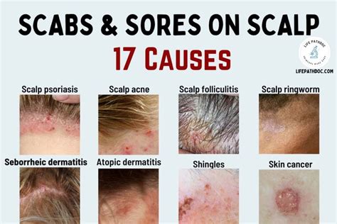 Scabs and Sores on Scalp: 17 Causes, Pictures and Treatment