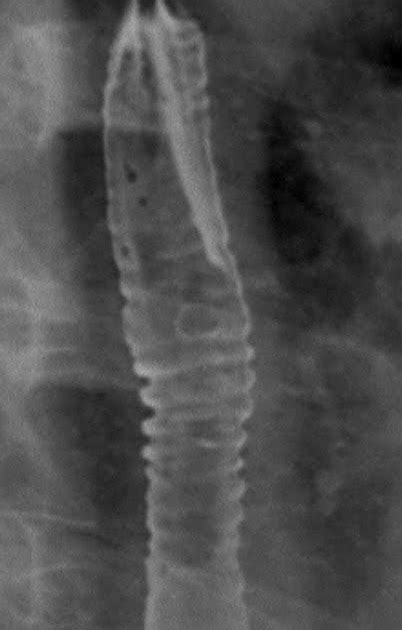 Roentgen Ray Reader: Idiopathic Eosinophilic Esophagitis