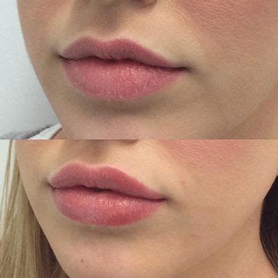 Lip fillers provide a quick and easy way to add extra volume and shape to lips. They deliver ...