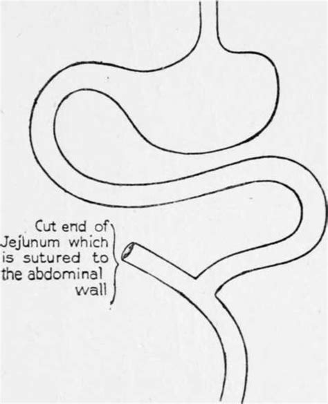 Jejunostomy Operation