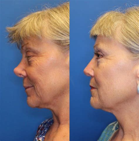 Nose Surgery Before & After Photos Patient 225 | San Francisco, CA | Kaiser Permanente Cosmetic ...