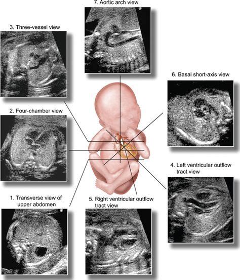 62 Fetal echo ideas | fetal, ultrasound, sonography