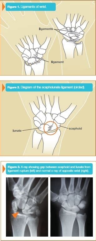 Wrist Sprain New York | Arthroscopic Surgery New York | White Plains