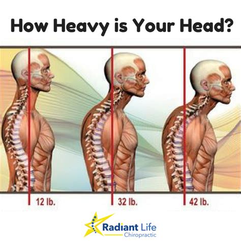 Understanding “Forward Head Posture” | Radiant Life Chiropractic