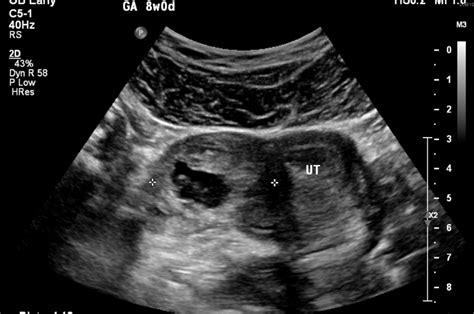 Ruptured Ectopic Pregnancy Ultrasound