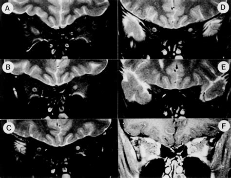 Neuritis: Retrobulbar Optic Neuritis Symptoms