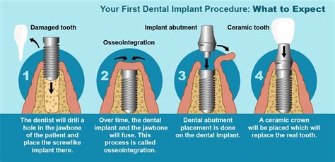 What is a Dental Implant? | Best Dental Clinic in Lucknow