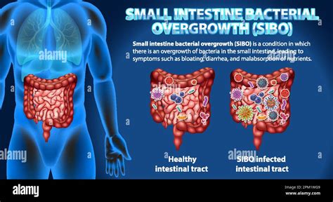 Small Intestine Bacterial Overgrowth (SIBO) illustration Stock Vector Image & Art - Alamy