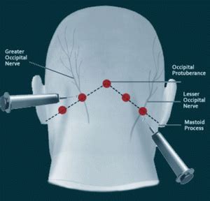 occipital-nerve-block-location - Complete Spine and Pain Care