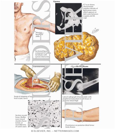 Russell's Blog: myositis ossificans histology