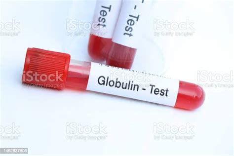 Globulin Test To Look For Abnormalities From Blood Stock Photo - Download Image Now - Analyzing ...