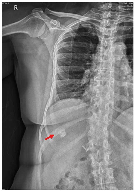 Hepatic Dystrophic Calcification Secondary to Transarterial Chemoembolization: Case Report and ...