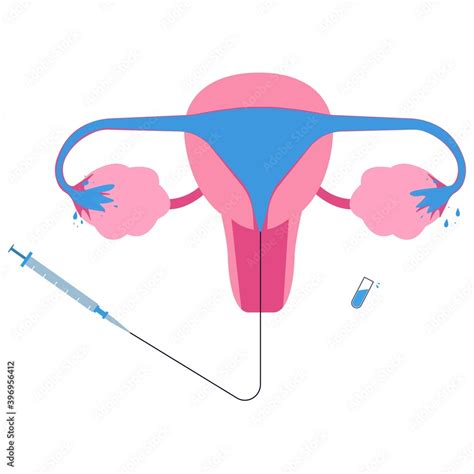 Hysterosalpingogram or HSG, x-ray procedure used to see fallopian tubes and uterus condition ...