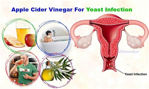 12 Tips Using Apple Cider Vinegar For Yeast Infection Treatment