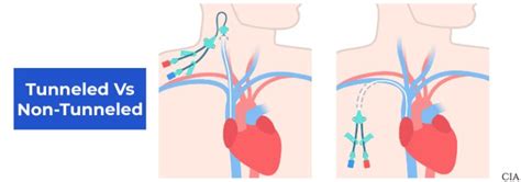 Tunneled vs Non-Tunneled Catheters: Differences & Examples