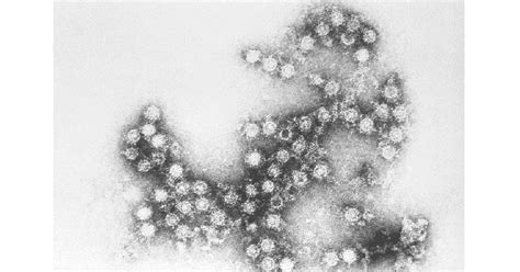 WAMC: Capital Region Schools Deal With Coxsackie Virus Outbreak - St. Peter's Health Partners News