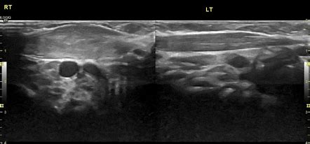 Fibromatosis colli | Radiology Reference Article | Radiopaedia.org