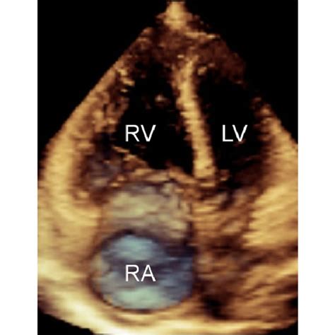 (PDF) Discriminatory ability of right atrial volumes with two- and three-dimensional ...