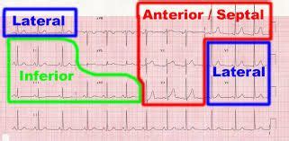 ekg leads lateral septal anterior - Google Search | Ekg interpretation ...