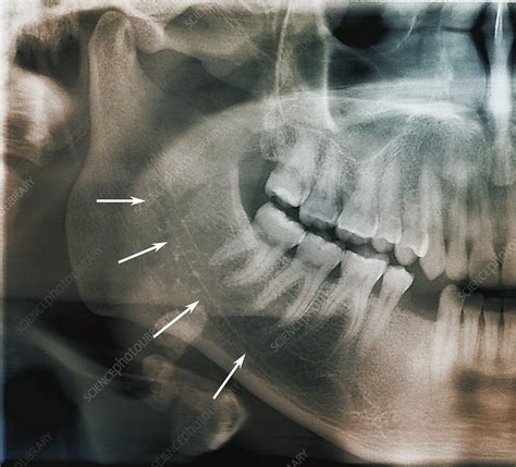 Mandibular canal and salivary gland stones, X-ray - Stock Image - C040/3270 - Science Photo Library