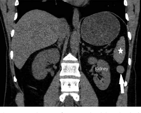 Structure of phrenicosplenic ligament | Semantic Scholar