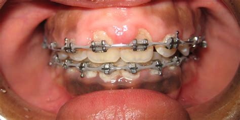 Swollen Gums, Overgrown gingiva during Orthodontic Treatment: Causes ...