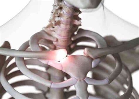 Sternoclavicular Joint Injury | SC Joint Injury | Orthopedic Shoulder Specialist| Manhattan ...