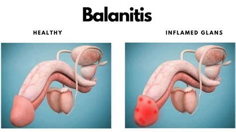 Balanitis