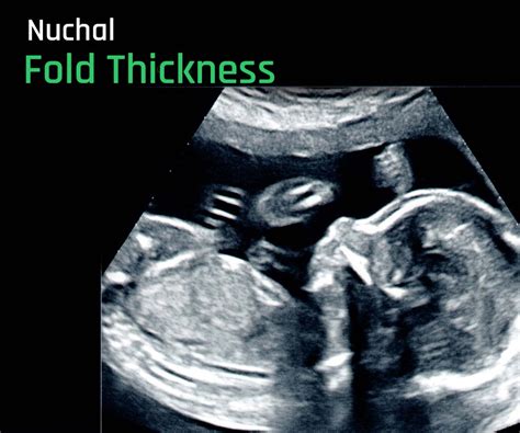 Nuchal Fold Thickness: Normal or abnormal? Expert insights in 2023