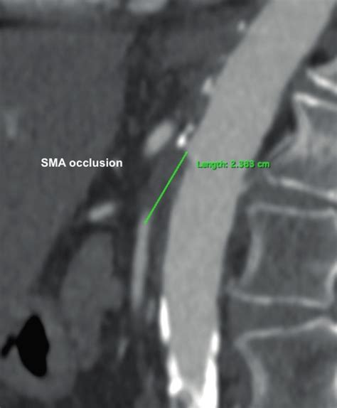 CT scan showing SMA occlusion. | Download Scientific Diagram