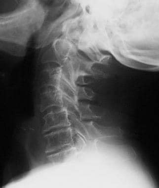 Rheumatoid Arthritis Spine Imaging: Practice Essentials, Radiography, Magnetic Resonance Imaging